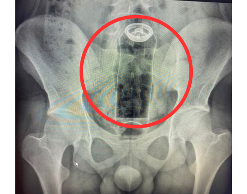 Jovem é internado após ficar com desodorante preso no reto; médico faz alerta