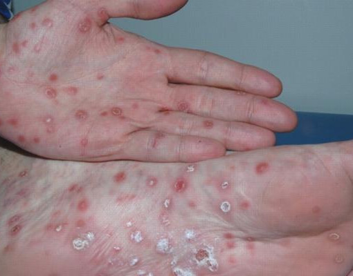 Mais de 5 mil casos de sífilis são registrados entre jovens no Piauí