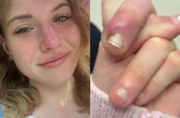 Jovem de 21 anos quase perde o dedo após infecção causada por roer unhas
